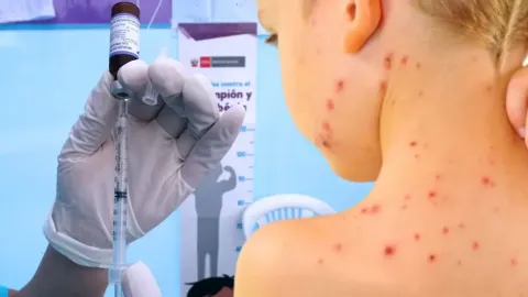 Vacuna contra el sarampión.